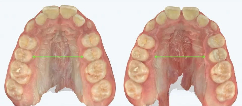 Expansão maxilar — resultado após disjunção — modelos digitais