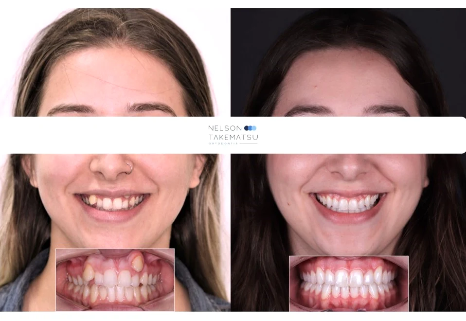 Caso Giulia — comparação facial antes e depois