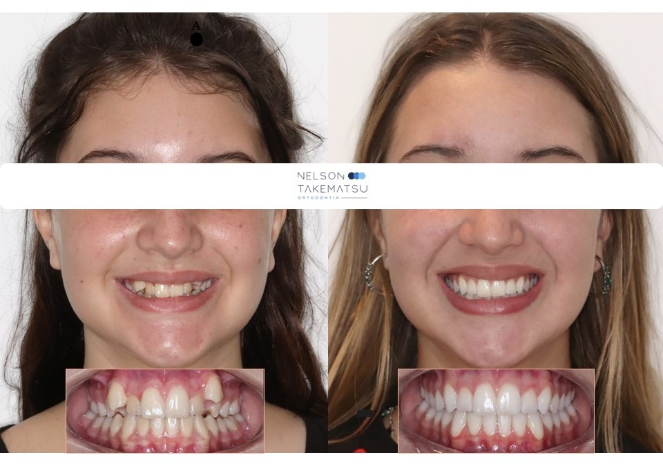 Caso Luana — comparação facial antes e depois