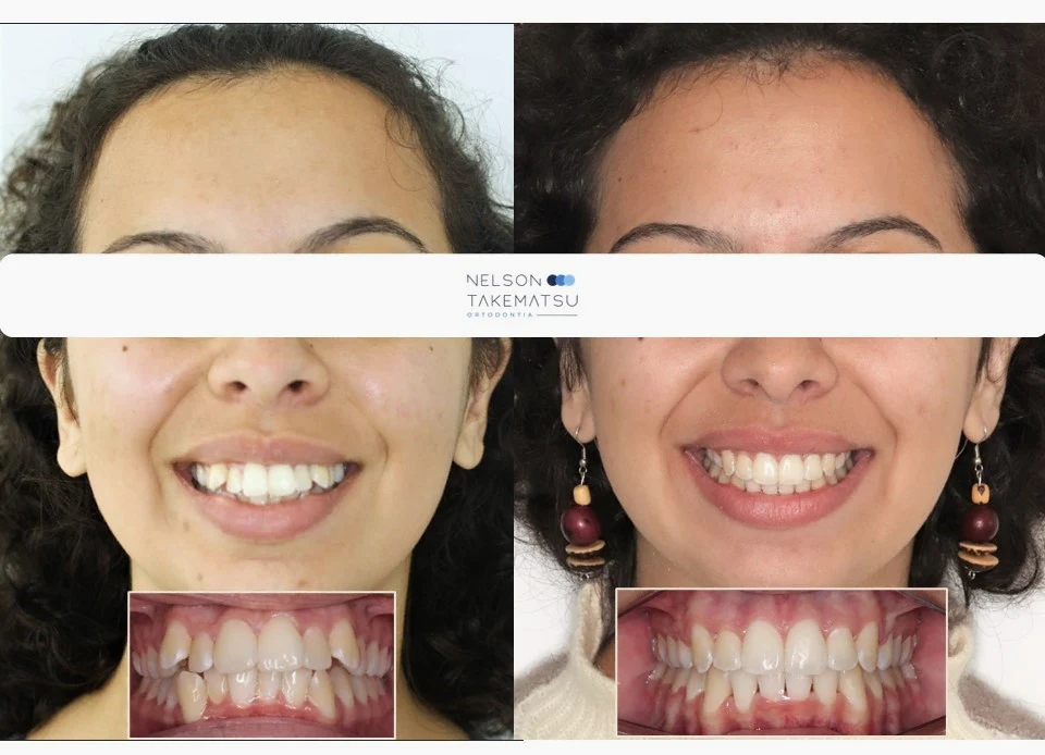 Caso Monique — comparação facial antes e depois